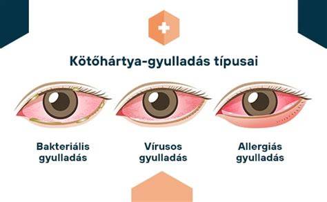 Infografika: kötőhártya-gyulladás típusai és kezelése