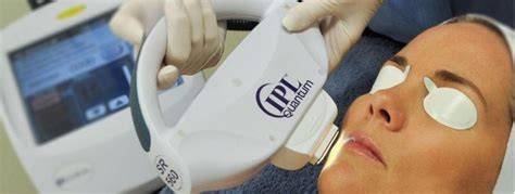 IPL arckezelés kezelés közben