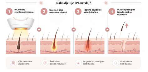 Infografika: IPL elvégzett hatásának és a kezelések ütemezésének áttekintése