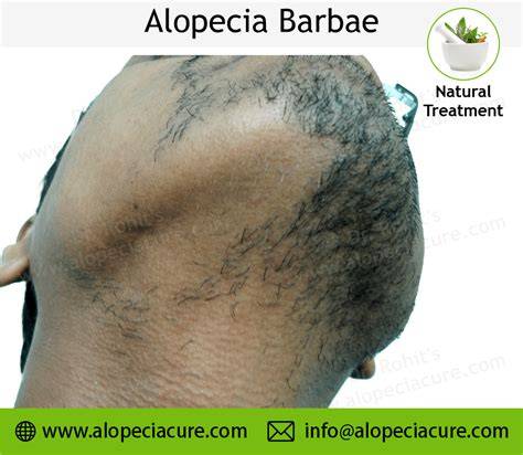 Ábra: alopecia barbae jellegzetes mintázata és diagnozisa