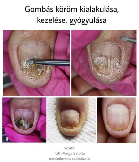 Gombás bőrelváltozások kezelése infografika
