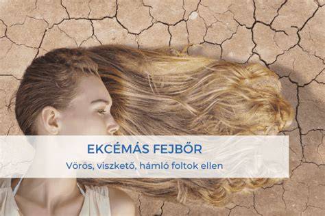 Fejbőr tünetek illusztráció: vörös foltok, hámlás, korpa
