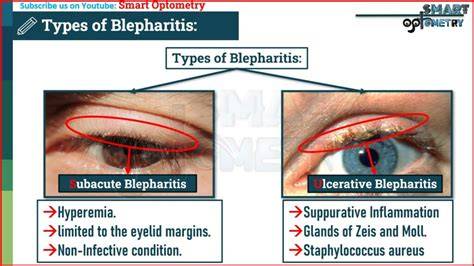 Blepharitis és szemhéj higiénia diagram