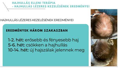 Trichoszkópia és hajhullás diagnosztika