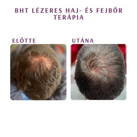 fejbőr és hajhullás áttekintő ábra