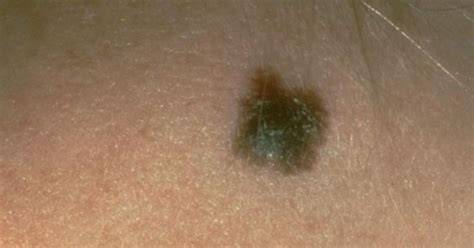 Ábra: A melanoma korai jelei a bőrtünetekben