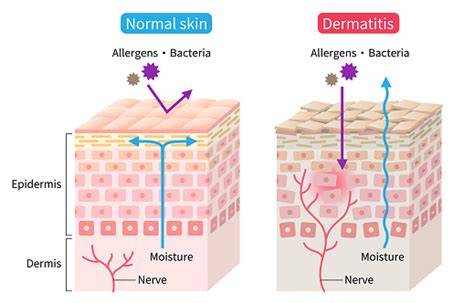 Infografika: atópiás dermatitisz tápvonalai és bőrápolási lépések