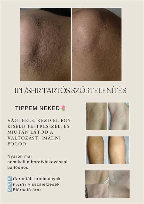 Infografika: tartós szőrtelenítés lépései és várható eredmények