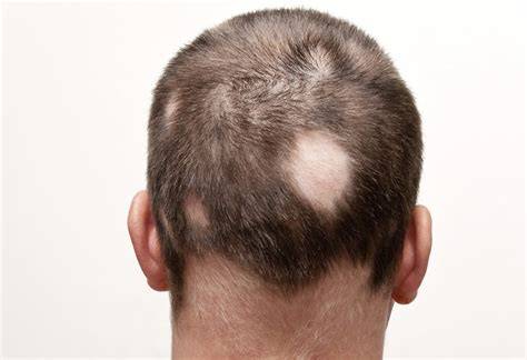 alopecia areata foltos hajhullás képe