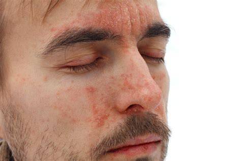 szeborreás dermatitis fejbőr ápolás diagram