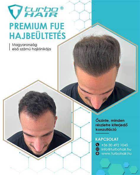 TurboHair Medical előtte-utána fotók