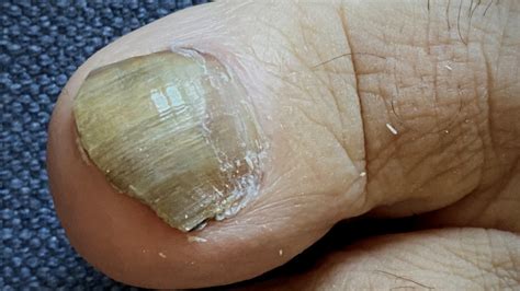 Sárgás, megvastagodott körömgomba tünetei