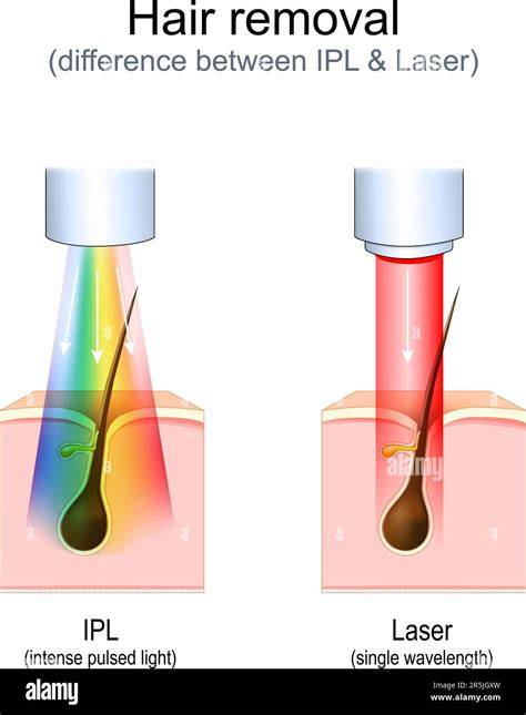 IPL vs. lézer: összehasonlító diagram