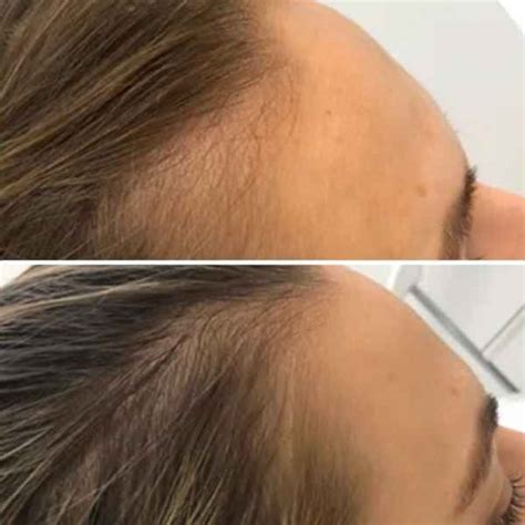 lézeres hajstimuláció