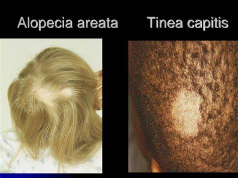 Összehasonlító ábra: alopecia areata, tinea capitis, szeborreás dermatitisz jellemzői