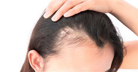 Diffúz vs. androgén alopecia jellegzetes mintázatai