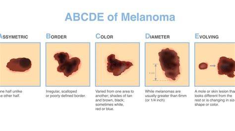 Infografika: A melanoma ABCDE szabálya - mit figyeljünk?