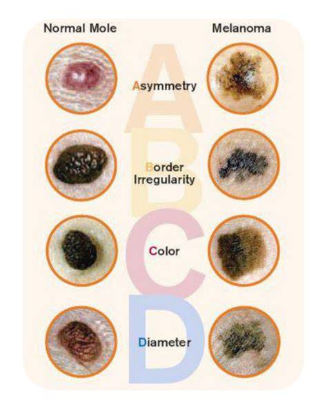 Infografika: Fejbőrön előforduló melanoma jellemzői és kockázatai