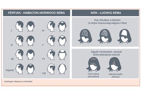 Infografika: a hajciklus és az egyes fázisok időtartama, valamint a hajhullás típusai