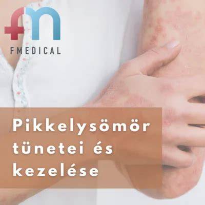 Infografika: pikkelysömör tünetei és lehetséges érintett területek