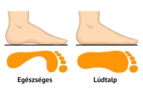 lúdtalp deformitás