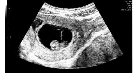 Ultrahang kép PCOS petefészekről