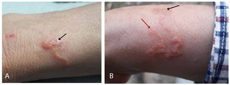 Vizsgálati példa: Cutaneous Pili Migrans vs. Cutaneous Larva Migrans