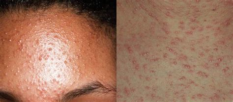 Malassezia gomba mikroszkóp alatt