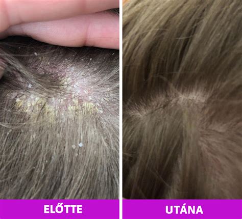 Különböző samponok szeborrea kezelésére