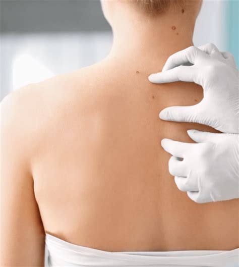 Dermatoszkópia a bőrelváltozások vizsgálatára