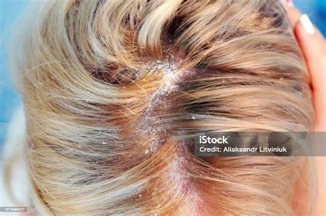 pikkelysömör a fejbőrön