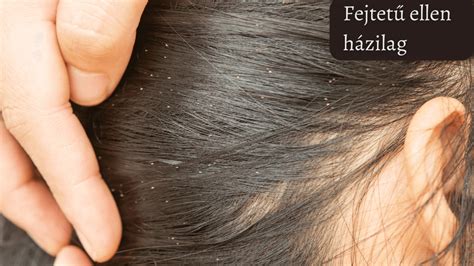 Illóolajak és növényi kivonatok a fejtetű elleni küzdelemben