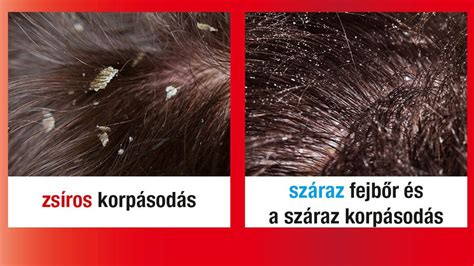 Korpa és zsíros korpásodás vizuális áttekintése (különbség a száraz és zsíros korpa között)