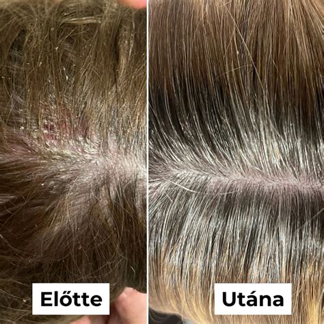 Fejbőr méregtelenítés infographic