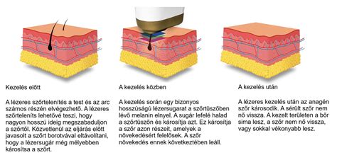 megfelelő szőrtelenítő kezelések összevetése