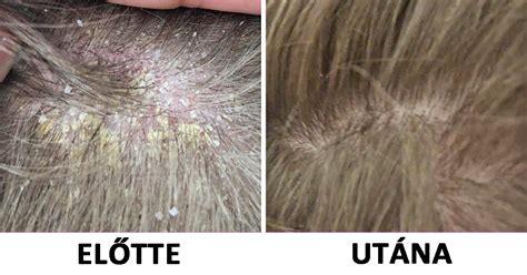 A korpa típusai és megjelenése