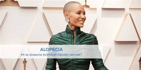 Infografika: a haj növekedési ciklusa és az alopecia típusai