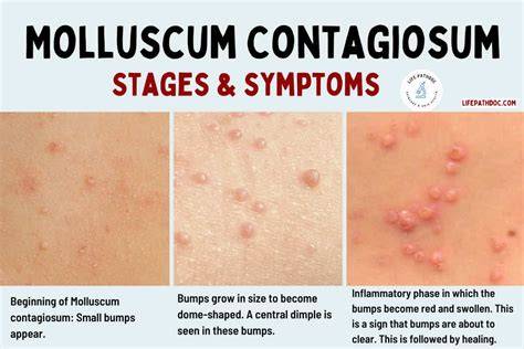 Clinical illustration: molluscum contagiosum kezelési lehetőségek